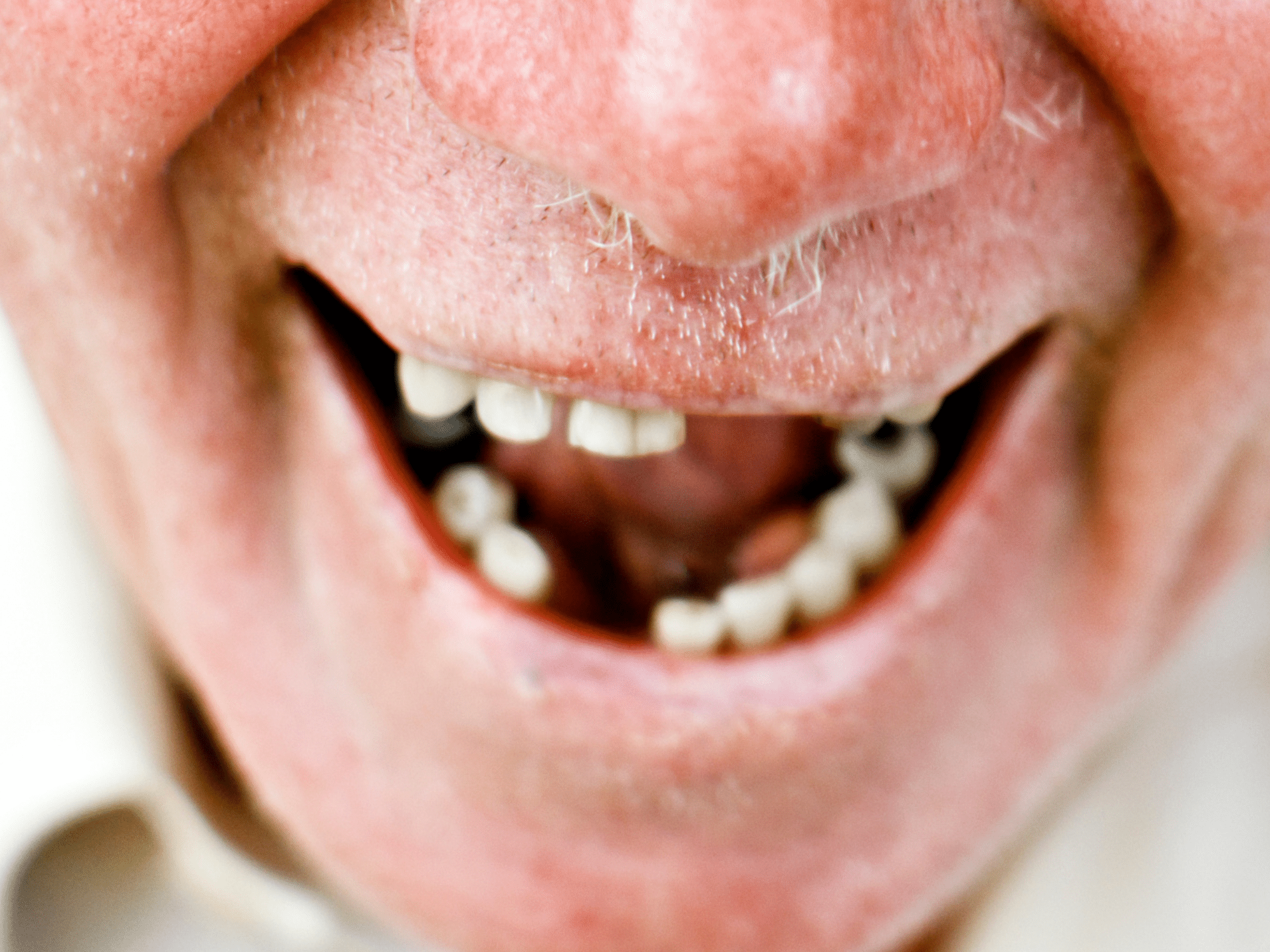 Dental Bridges in Essex and Thurrock - Tooth Doctor
