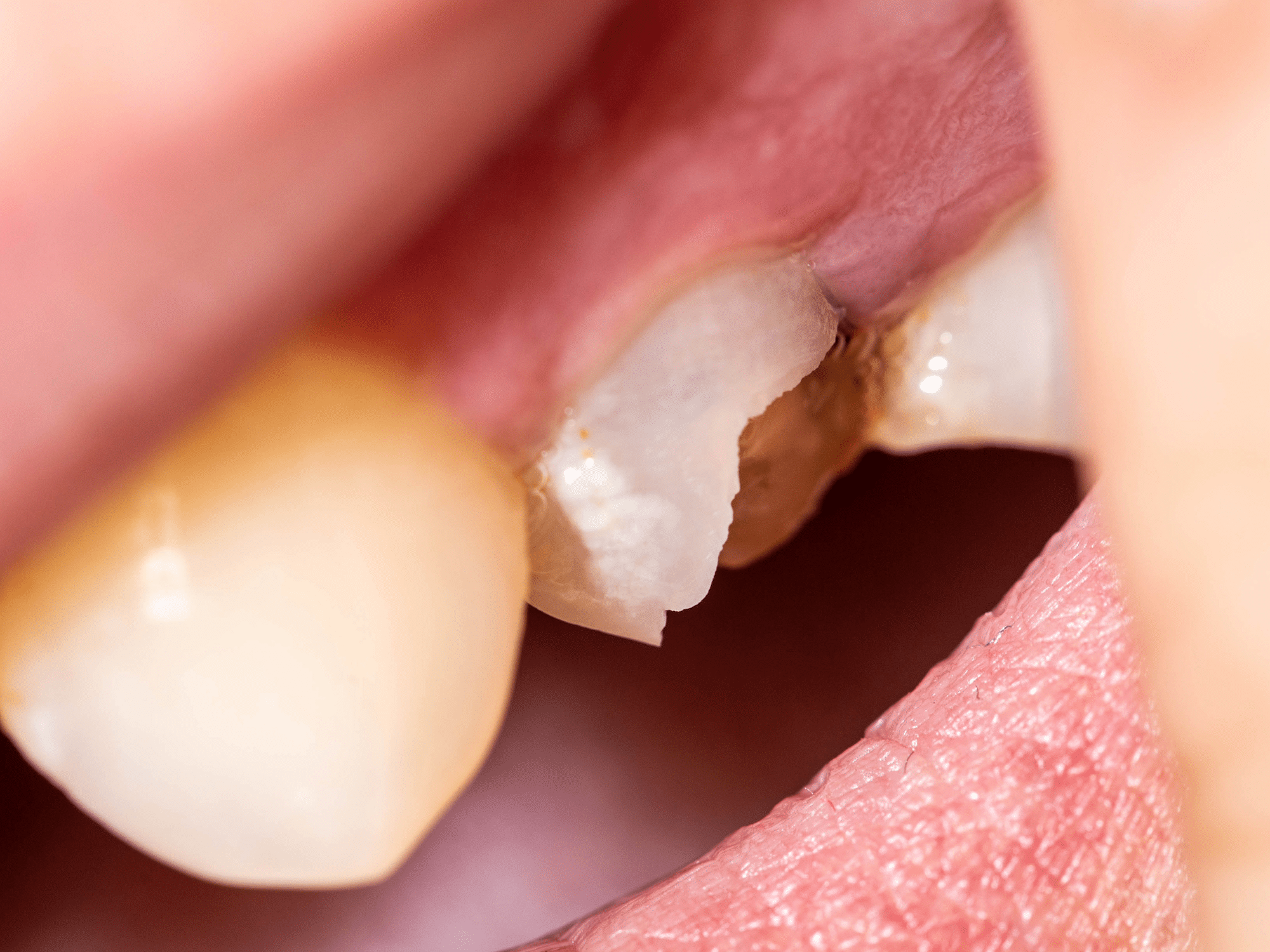 Who Need Dental Crowns - Tooth Doctor - Dentist in Essex and Thurrock