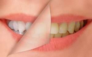 Teeth Whitening Remove Smoking Stains