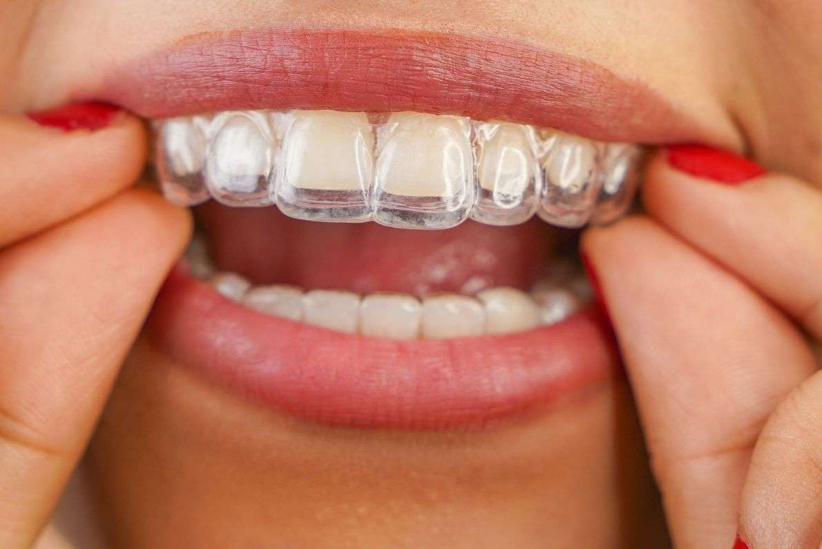 Tooth Doctor Stanford-le-Hope - Free Invisalign Consultation